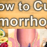 An Introduction to Natural Hemorrhoids Treatments
